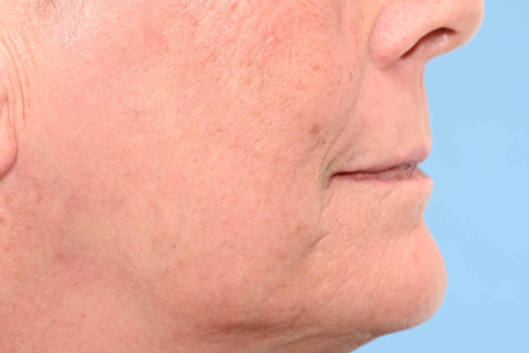 1-Post-IPL-Laser-Co2-Profond-crop-opt