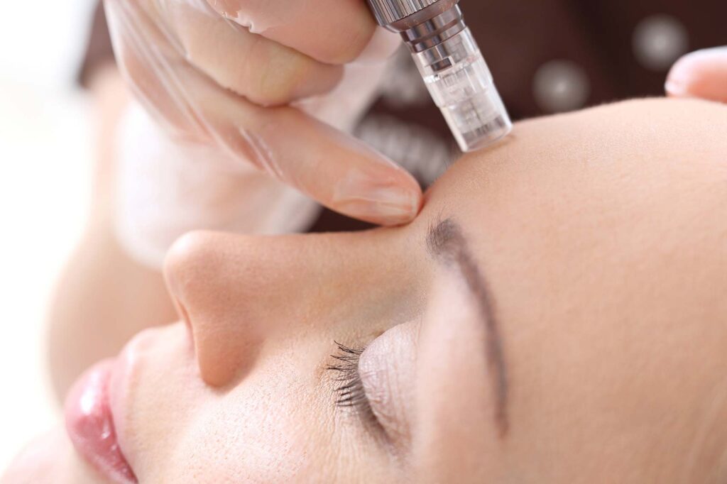microneedling (microaiguillage) en clinique