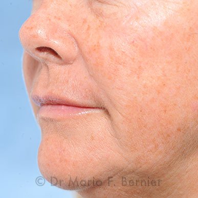 Photorajeunissement - Avant