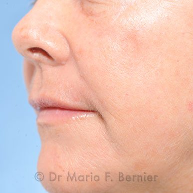 Photorajeunissement - Après