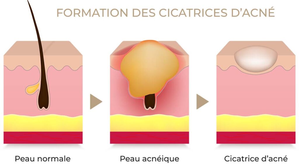 formation des cicatrices d’acné