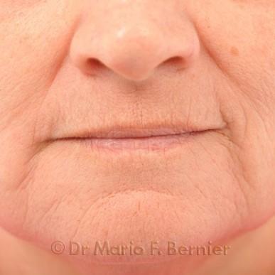 Traitement IPL et laser visage - Après