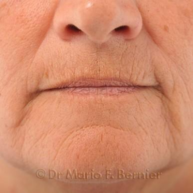 Traitement IPL et laser visage - Avant