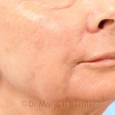 Traitement IPL visage - Après