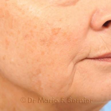 Traitement IPL visage - Avant