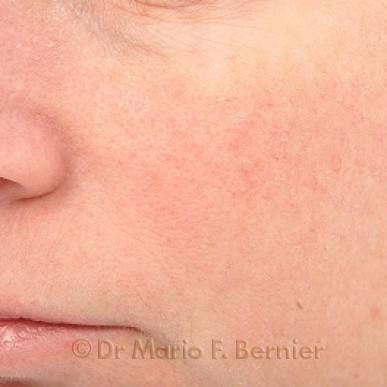 Traitement IPL couperose - Après