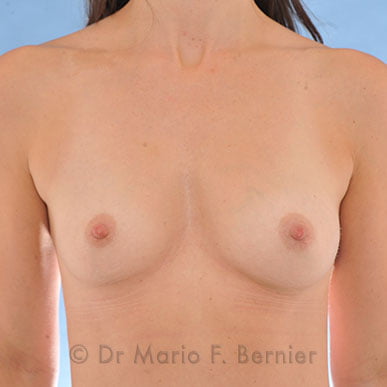 correction asymétrie mammaire - Avant