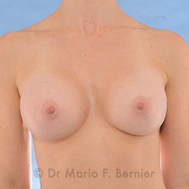 correction asymétrie mammaire - Après