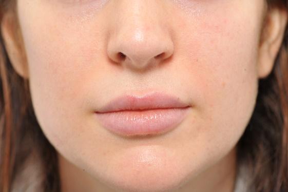 Injection des lèvres - Après