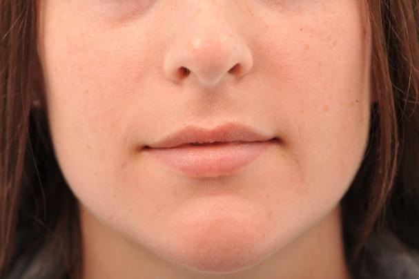 Injection des lèvres - Avant