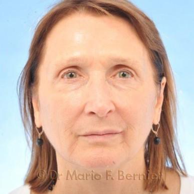 ajeunissement du visage - Après