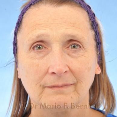 rajeunissement du visage - Avant