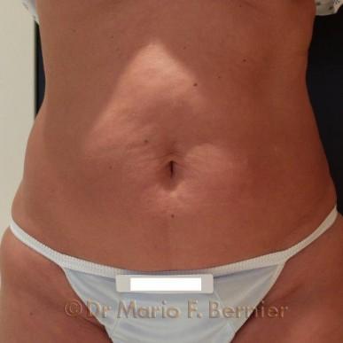 traitement radiofréquence ventre Venus Legacy - Après