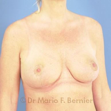 diminution mammaire - Après