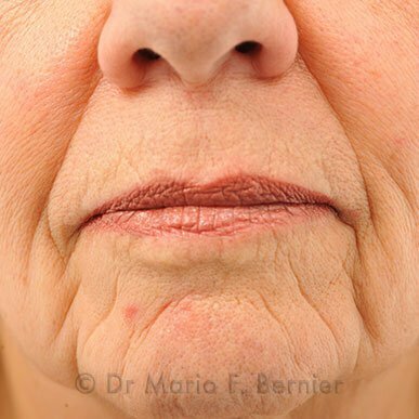 injections visage - Avant