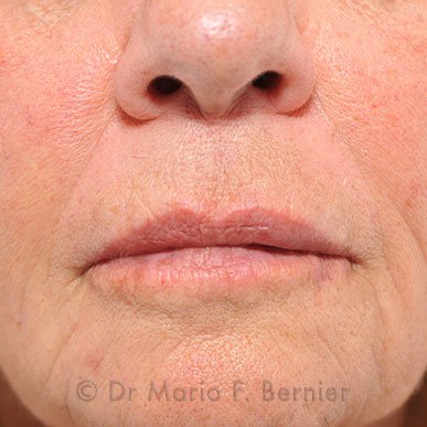 injections visage - Après