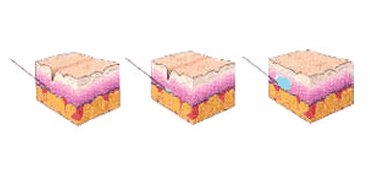 Figure 1 - Injections d’acide hyaluronique