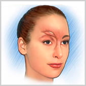 Injections de toxine botulinique pour traiter les rides entre les sourcils