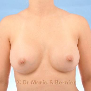 augmentation mammaire et correction des mamelons inversés - Après