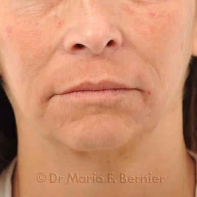 injections acide hyaluronique - Après