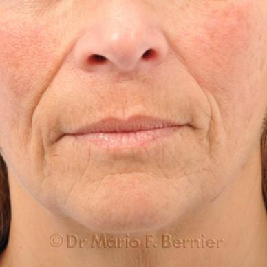 injections acide hyaluronique - Avant