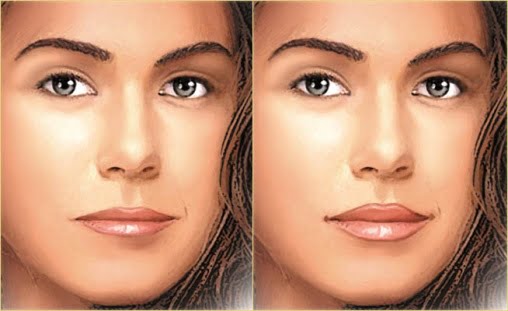 augmentation des lèvres avec l’acide hyaluronique