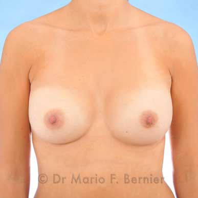 augmentation mammaire 330 cc après