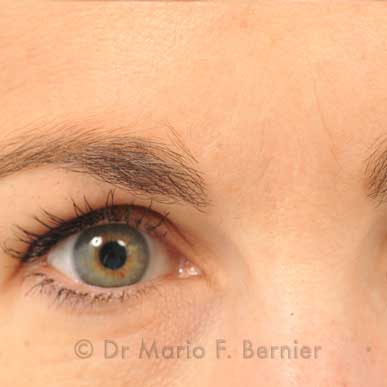 injections de Botox au niveau de la glabelle - après