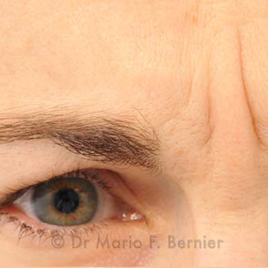 injections de Botox au niveau de la glabelle - avant