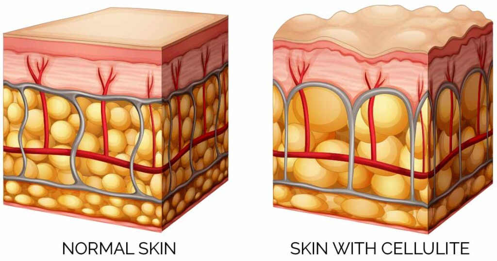 skin without or with cellulite