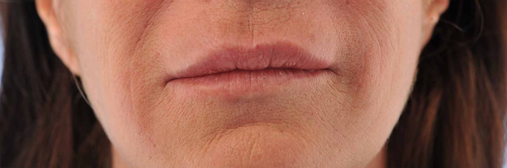 Laser-Co2-+IPL+-injestions-Restylane-apres