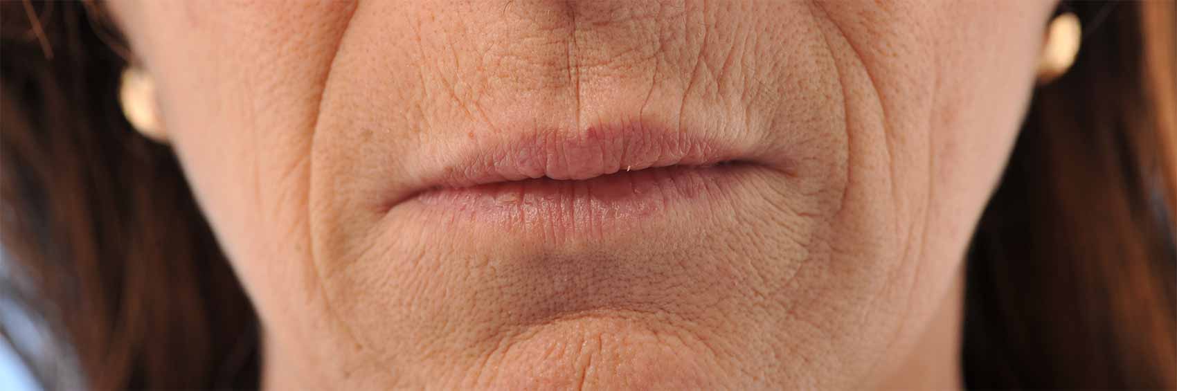 Laser-Co2-+IPL+-injestions-Restylane-avant