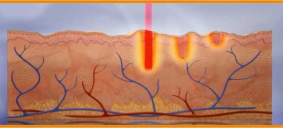 laser fractionnel CO2 pour traitement des cicatrices