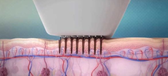 radiofréquence nanofractionnelle Venus Viva