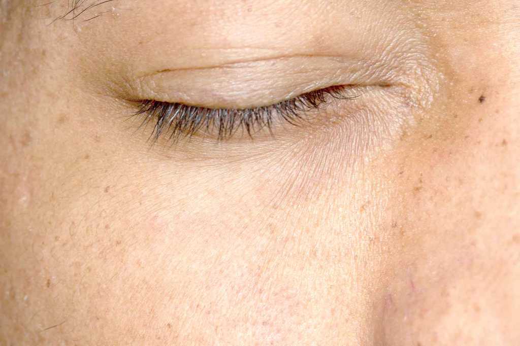 hyperpigmentation de la peau - taches brunes