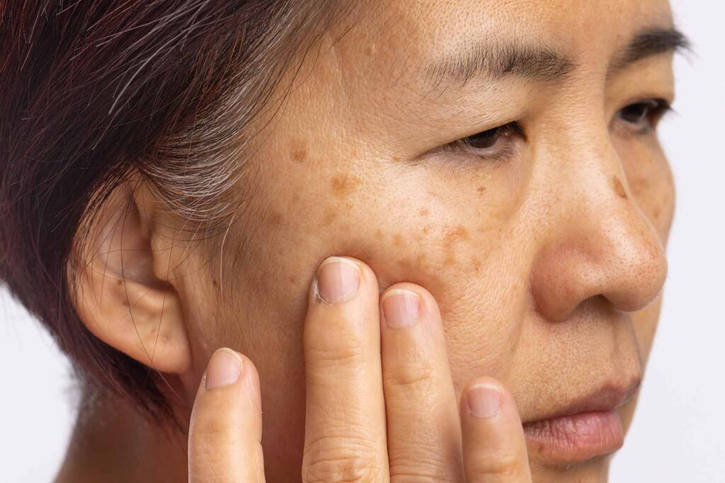taches brunes sur le visage